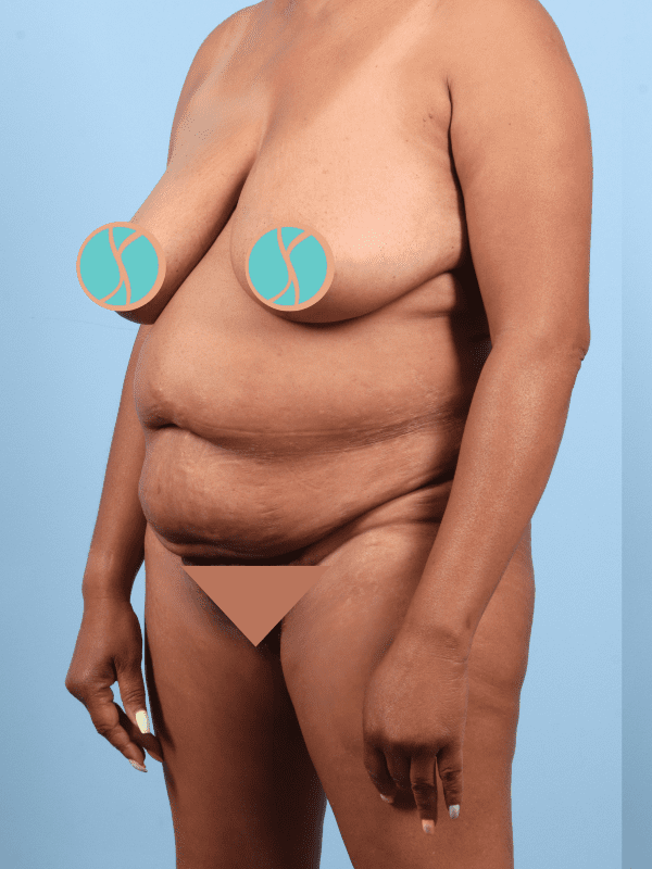 Abdominoplasty Patient Photo - Case 12378 - before view-3