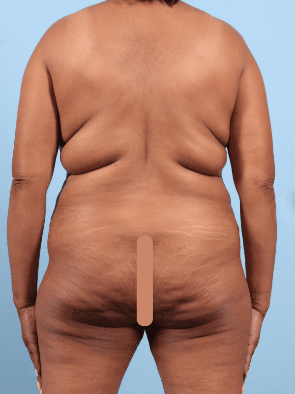 Abdominoplasty Patient Photo - Case 12378 - before view-5