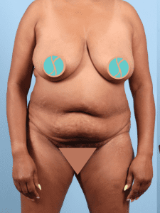 Abdominoplasty - Case 12378 - Before