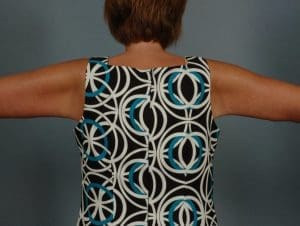 Arm Lift - Case 12392 - After