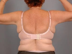 Arm Lift - Case 12396 - After