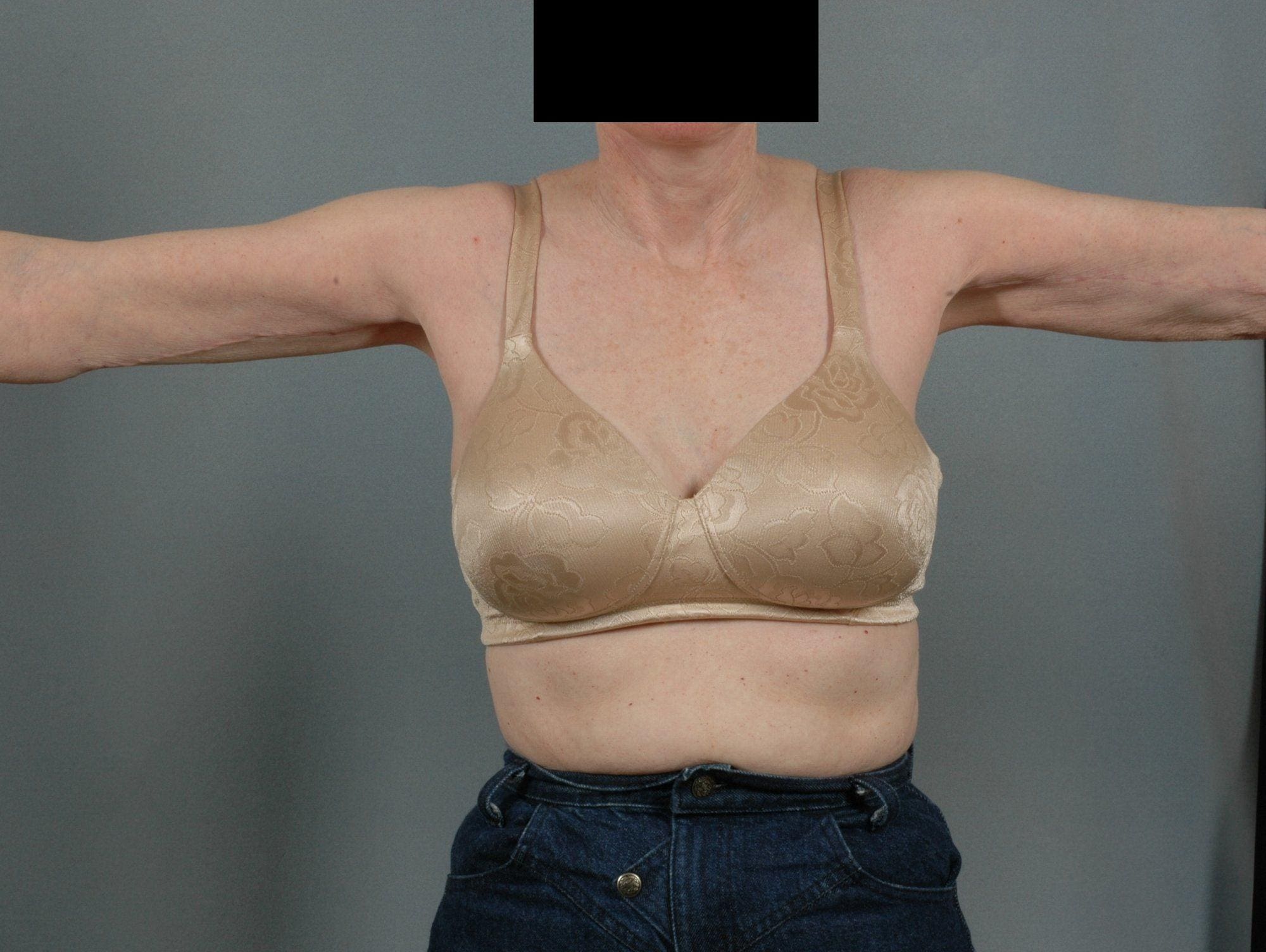 Arm Lift Patient Photo - Case 12404 - after view