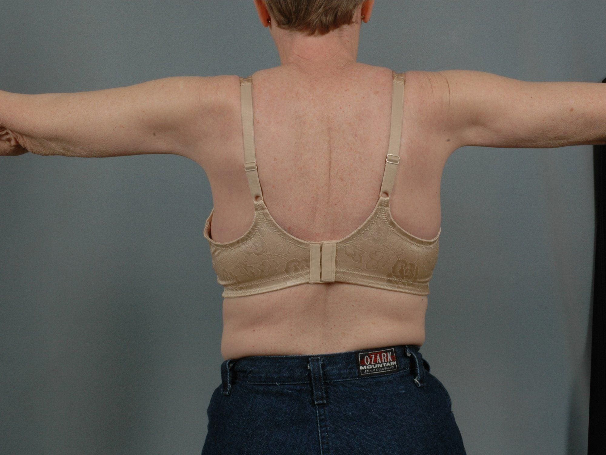 Arm Lift Patient Photo - Case 12404 - after view-1