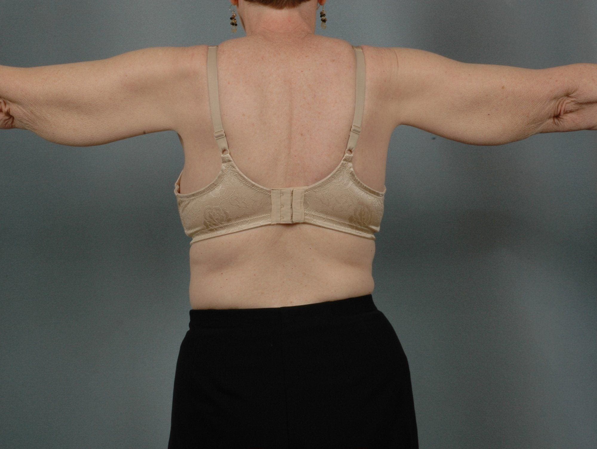 Arm Lift Patient Photo - Case 12404 - before view-1