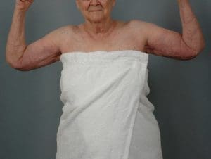Arm Lift - Case 12411 - After