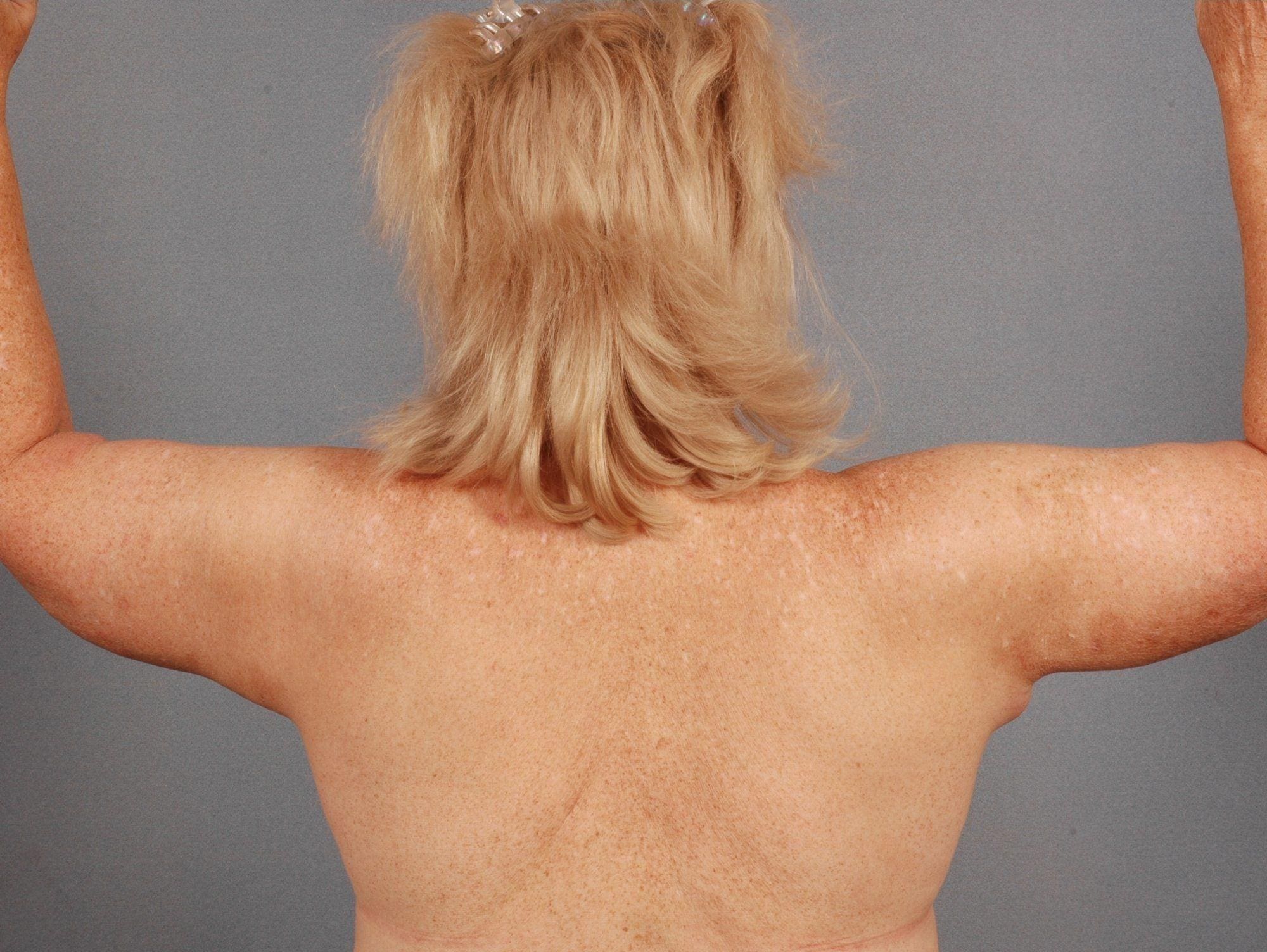 Arm Lift Patient Photo - Case 12417 - after view