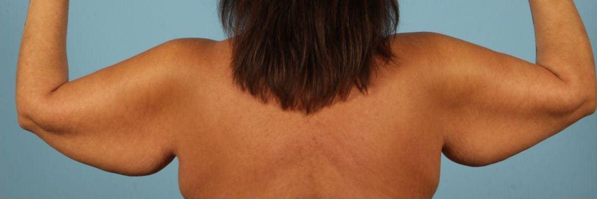 Arm Lift Patient Photo - Case 12421 - before view-1