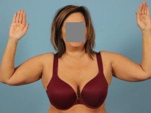 Arm Lift - Case 12427 - Before