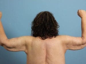 Arm Lift - Case 12433 - After