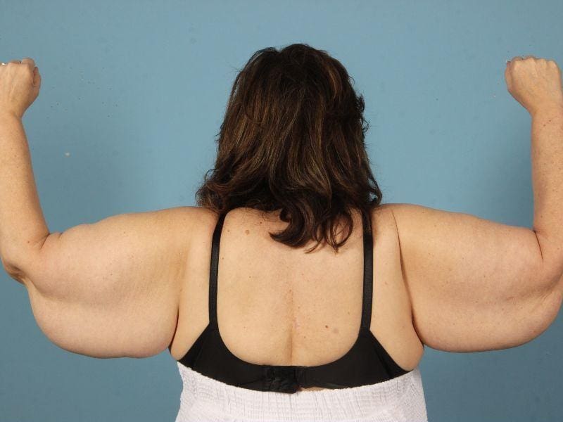 Arm Lift Patient Photo - Case 12433 - before view-