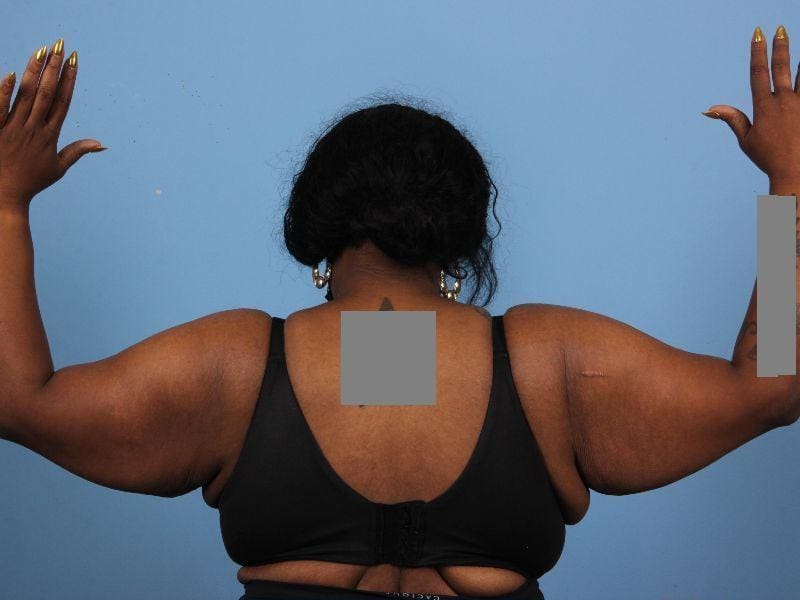 Arm Lift Patient Photo - Case 12441 - before view-1