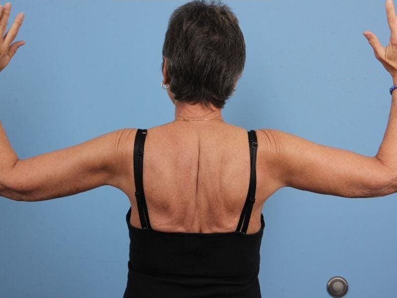Arm Lift Patient Photo - Case 12448 - after view-1