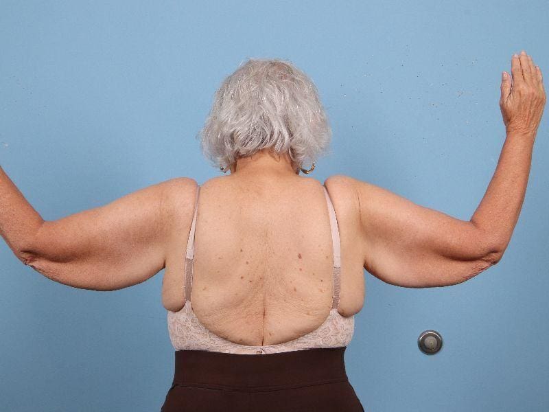 Arm Lift Patient Photo - Case 12466 - before view-1