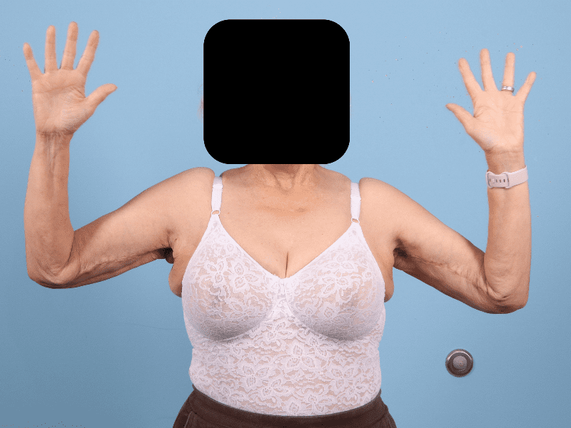 Arm Lift Patient Photo - Case 12466 - after view