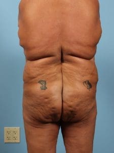 Brazilian Butt Lift - Case 12472 - Before