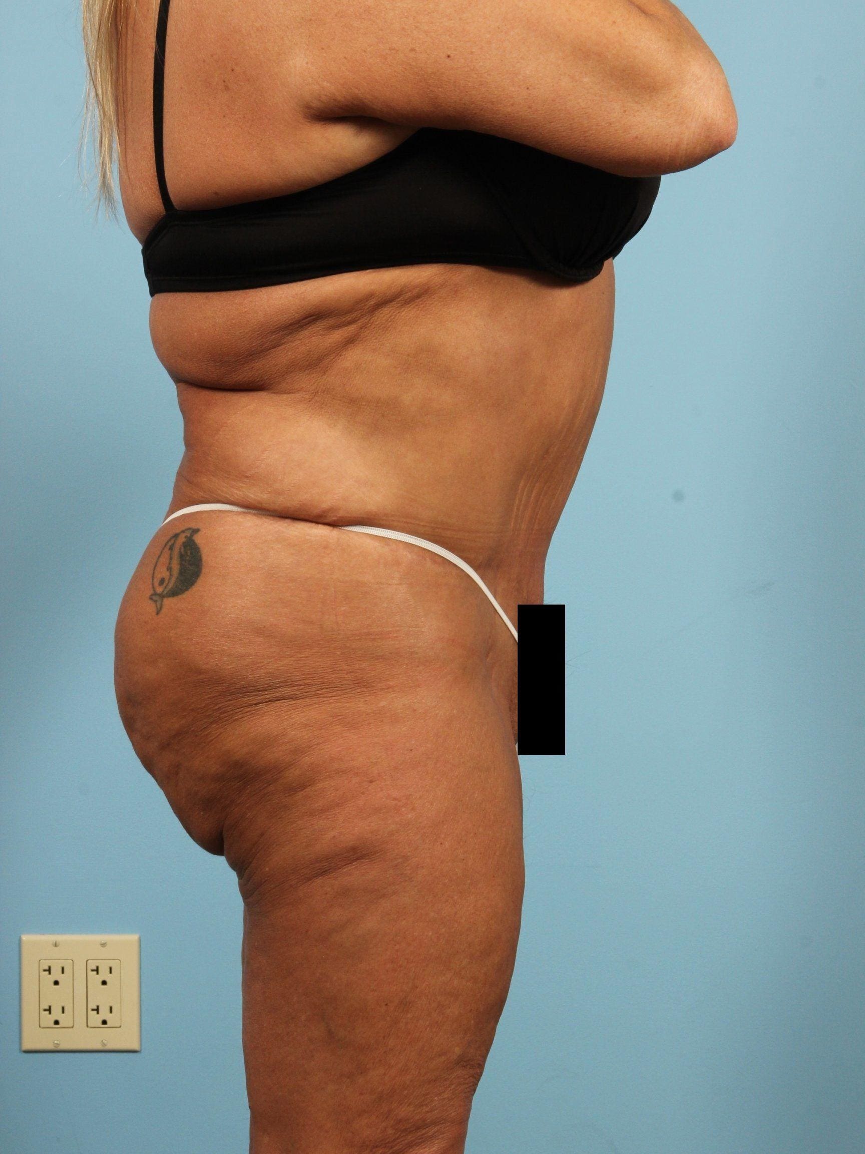 Brazilian Butt Lift Patient Photo - Case 12472 - after view-2