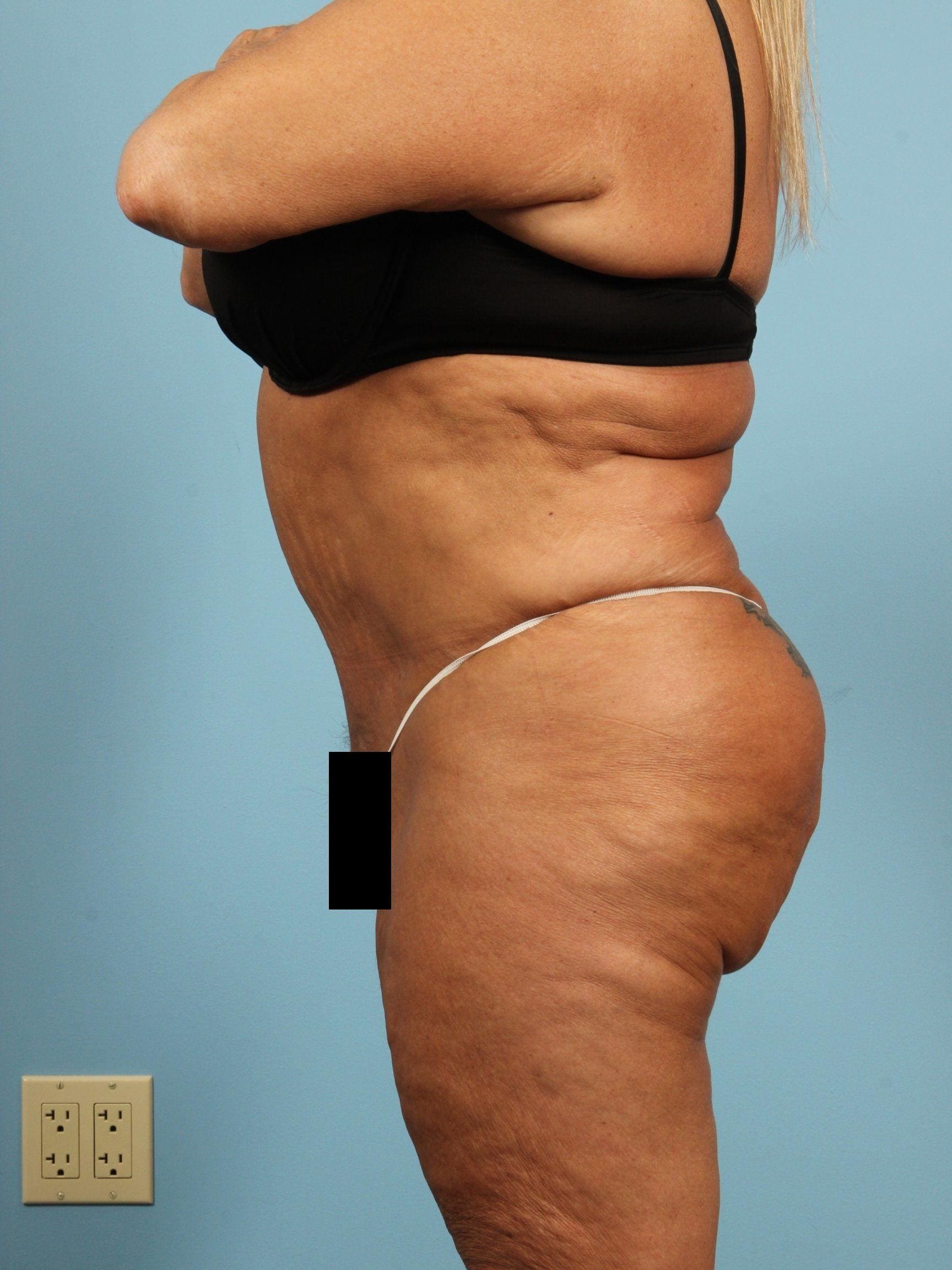 Brazilian Butt Lift Patient Photo - Case 12472 - after view-1