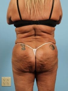 Brazilian Butt Lift - Case 12472 - After