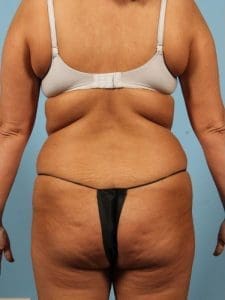 Brazilian Butt Lift - Case 12480 - Before