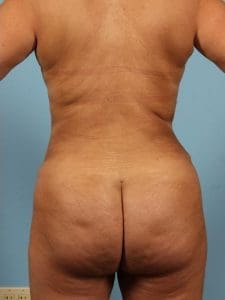 Brazilian Butt Lift - Case 12480 - After