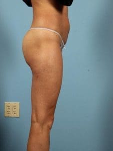 Brazilian Butt Lift - Case 12486 - After