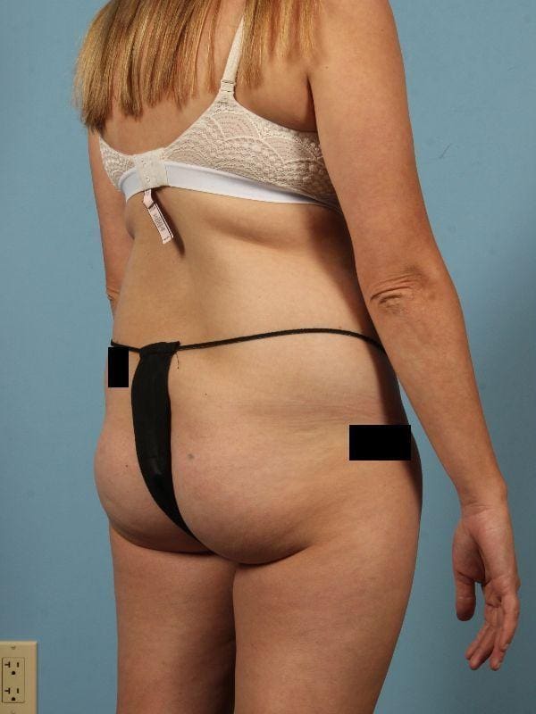 Brazilian Butt Lift Patient Photo - Case 12493 - before view-4