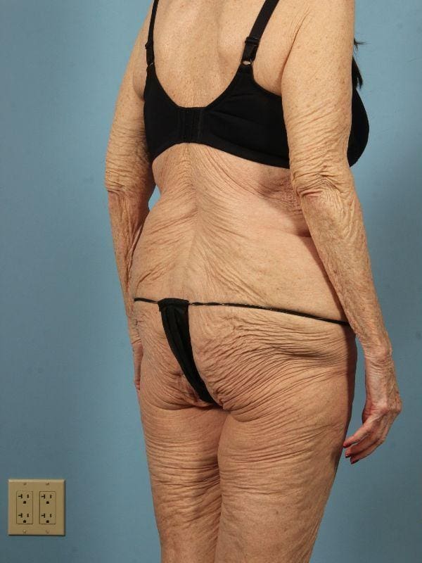 Brazilian Butt Lift Patient Photo - Case 12505 - before view-4