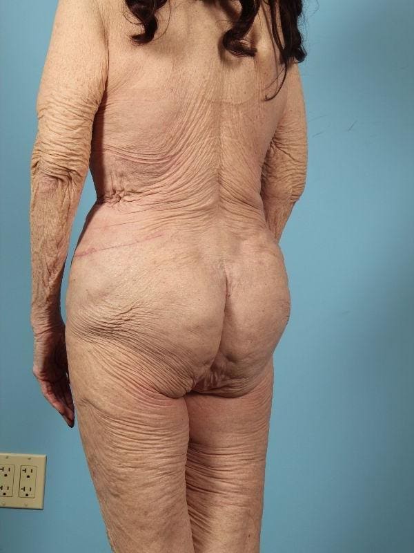 Brazilian Butt Lift Patient Photo - Case 12505 - after view-3