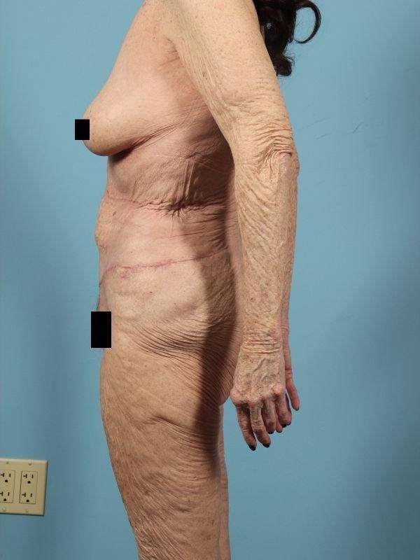 Brazilian Butt Lift Patient Photo - Case 12505 - after view-1