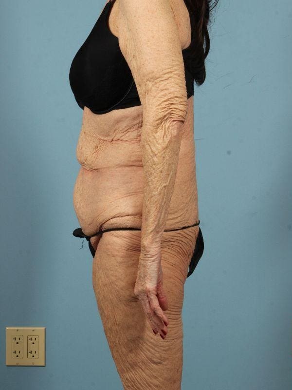 Brazilian Butt Lift Patient Photo - Case 12505 - before view-1