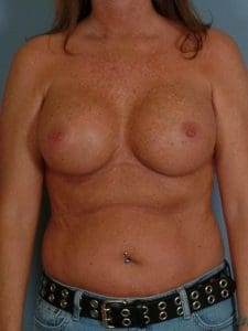 Breast Augmentation - Case 12517 - After