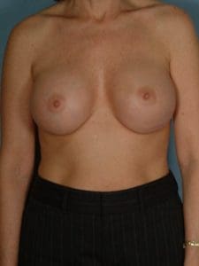 Breast Augmentation - Case 12541 - After