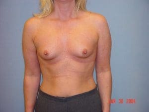 Breast Augmentation - Case 12549 - Before