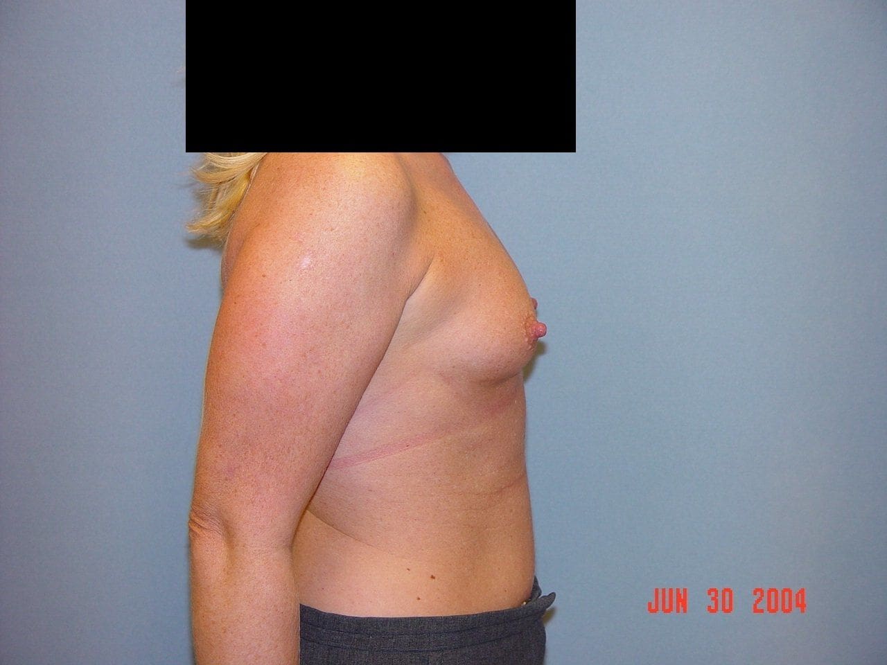 Breast Augmentation Patient Photo - Case 12549 - before view-2