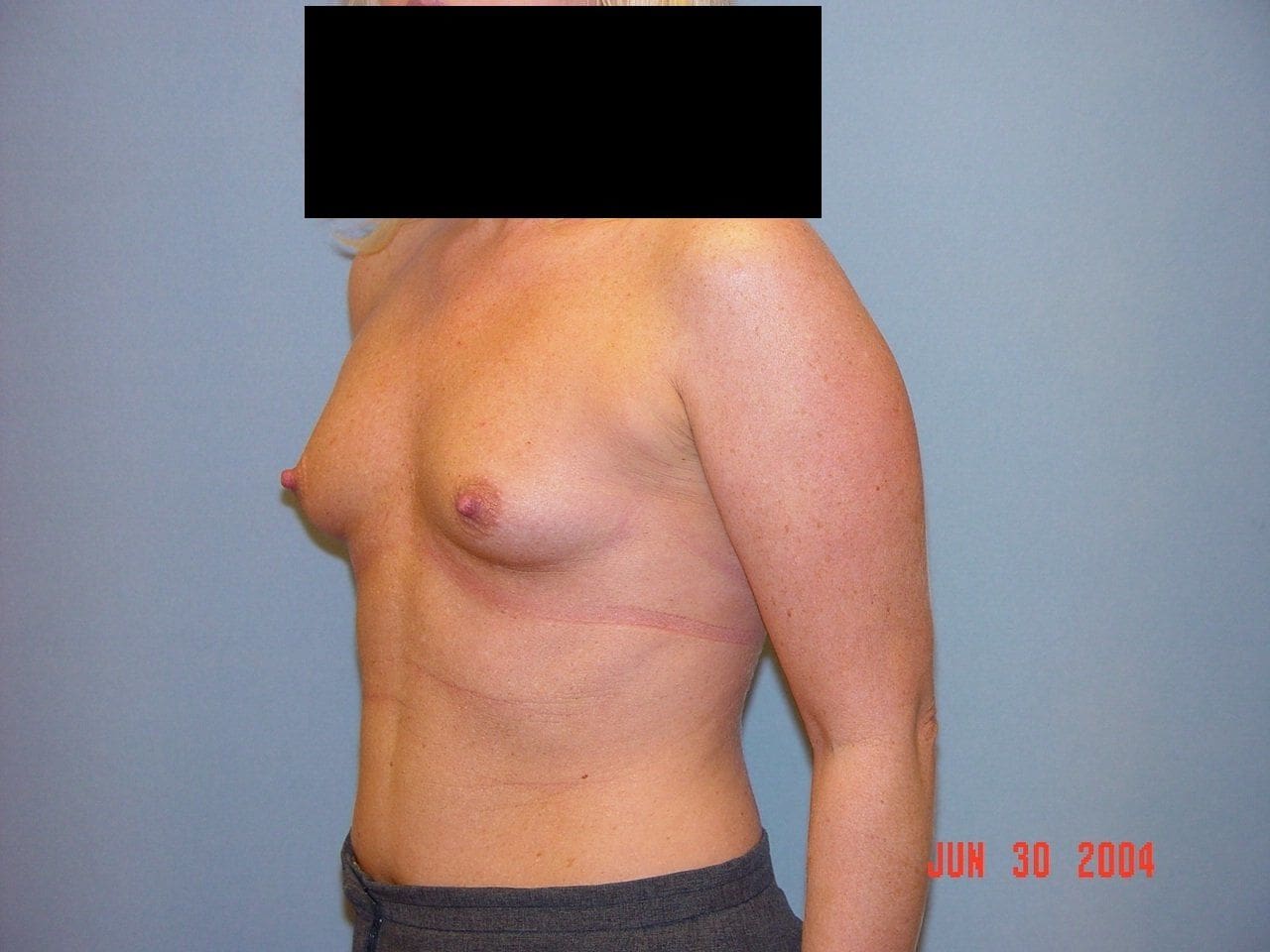 Breast Augmentation Patient Photo - Case 12549 - before view-3