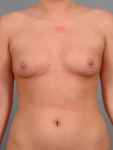 Breast Augmentation - Case 12561 - Before