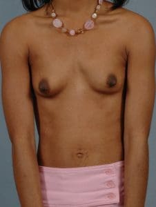 Breast Augmentation - Case 12573 - Before