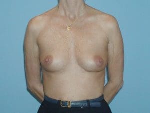Breast Augmentation - Case 12585 - Before