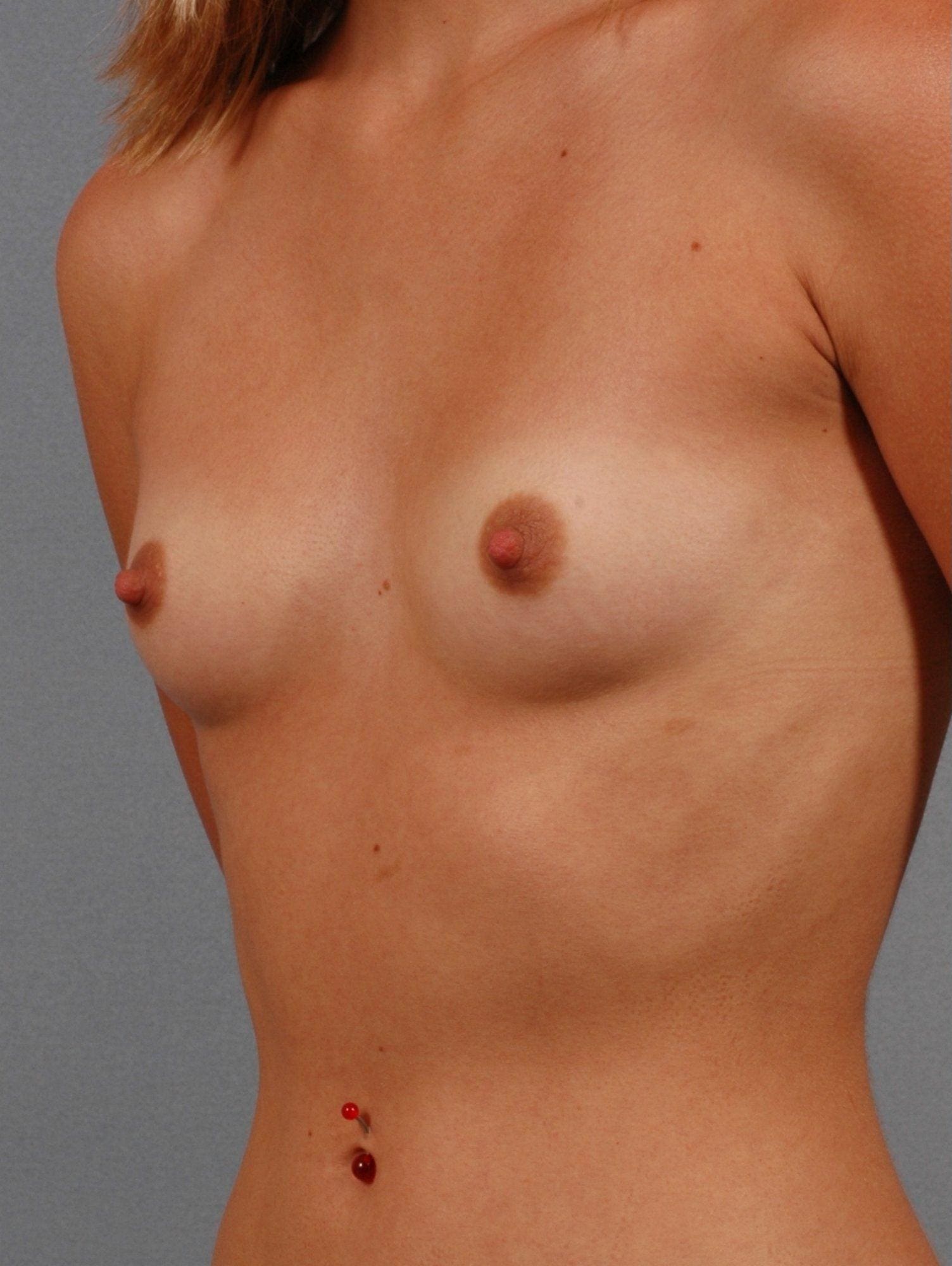 Breast Augmentation Patient Photo - Case 12597 - before view-3