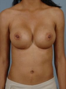 Breast Augmentation - Case 12609 - After