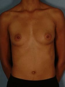 Breast Augmentation - Case 12609 - Before