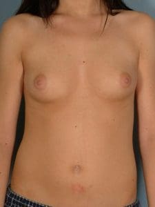Breast Augmentation - Case 12621 - Before