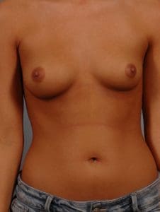 Breast Augmentation - Case 12646 - Before