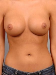 Breast Augmentation - Case 12646 - After