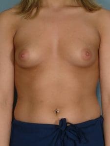 Breast Augmentation - Case 12668 - Before