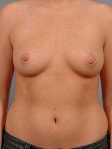 Breast Augmentation - Case 12681 - Before