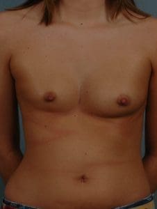 Breast Augmentation - Case 12705 - Before