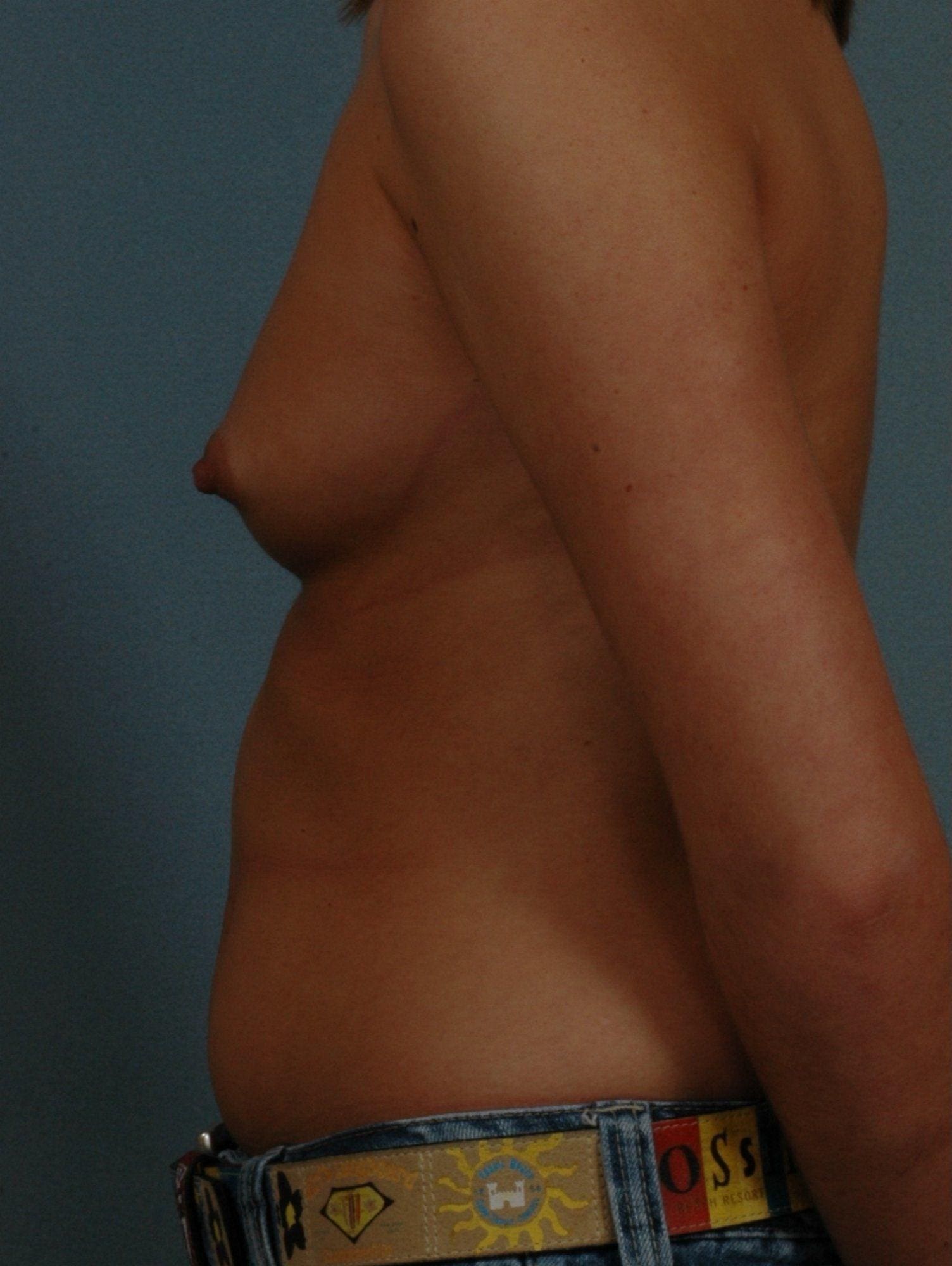 Breast Augmentation Patient Photo - Case 12705 - before view-1