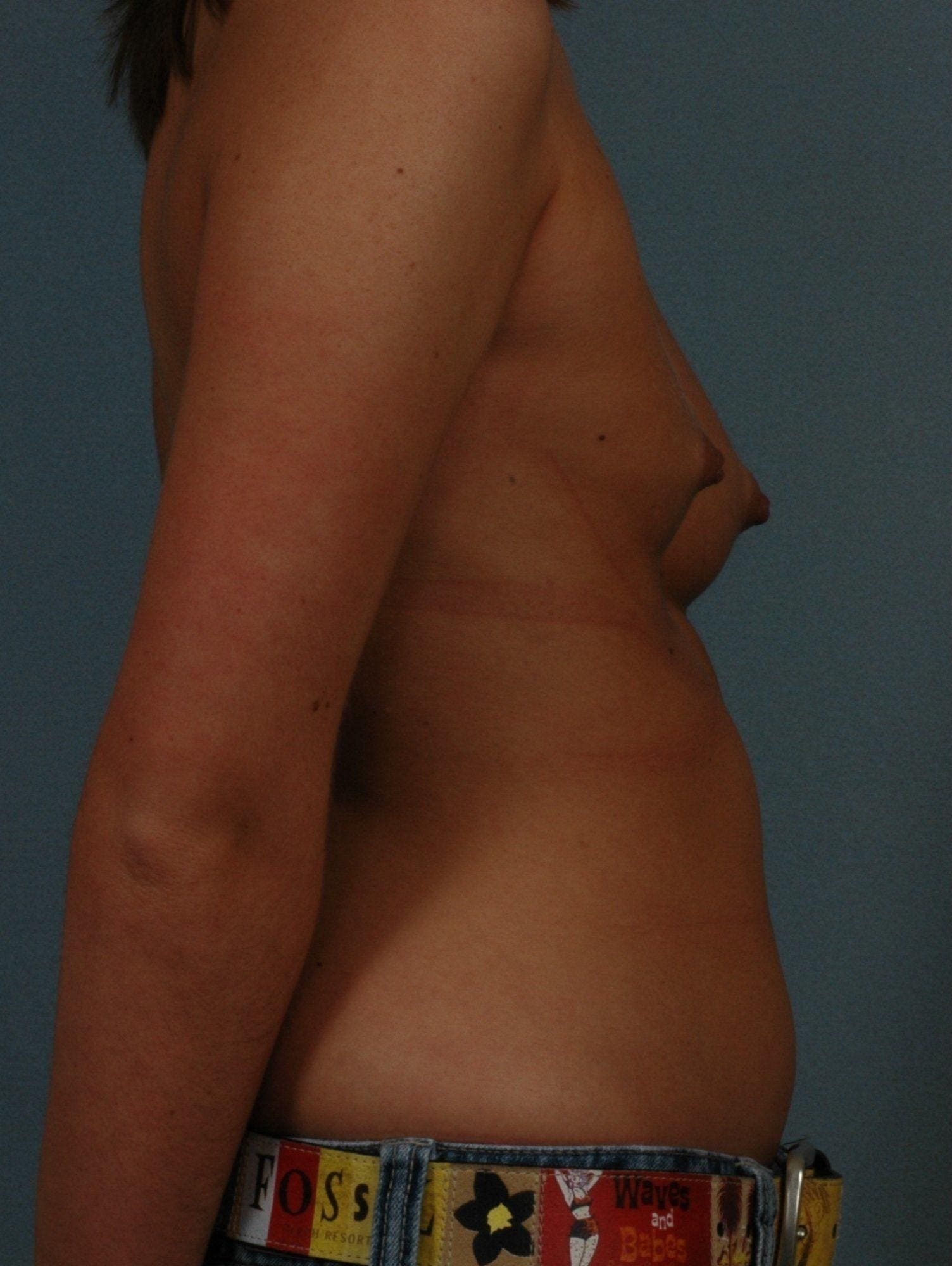 Breast Augmentation Patient Photo - Case 12705 - before view-2
