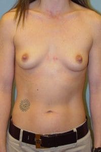 Breast Augmentation - Case 12718 - Before